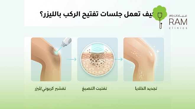 صورة-توضح-جلسات-تفتيح-الركب-بالليزر