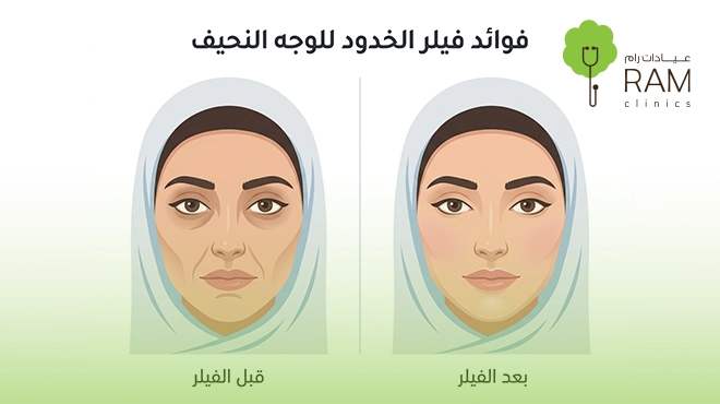 صورة-توضح-مميزات-فيلر-الخدود-للوجه-النحيف