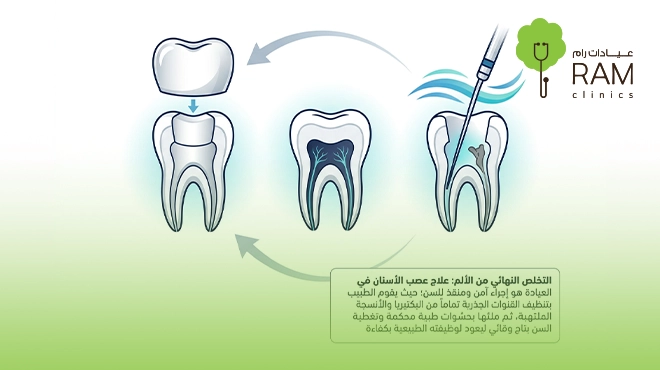 صورة-توضح-طرق-علاج-عصب-الاسنان
