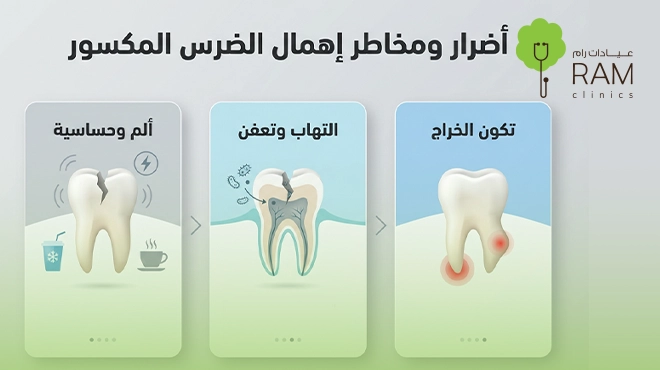 مخاطر-إهمال-الضرس-المكسور