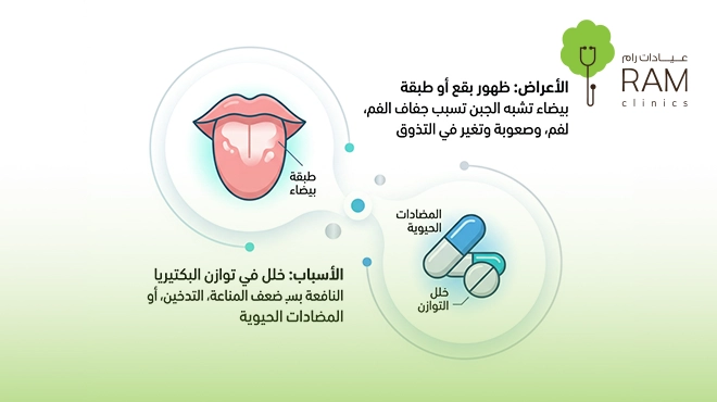 اسباب-وجود-فطريات-على-اللسان
