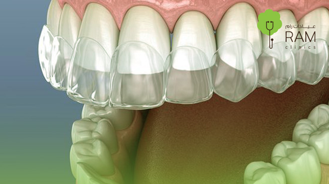 كل ما تريد معرفته عن تقويم الأسنان وأسعاره