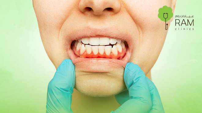 سرطان-اللثة