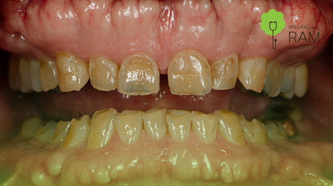 تآكل الأسنان الأمامية