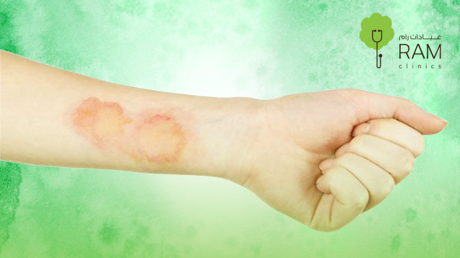 عمليات-الترقيع