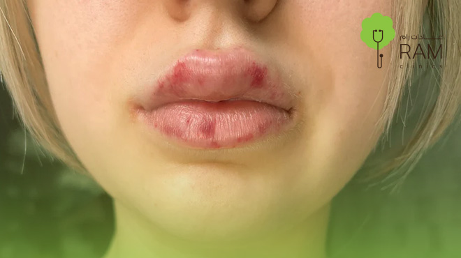 الشفايف-بعد-الفيلر