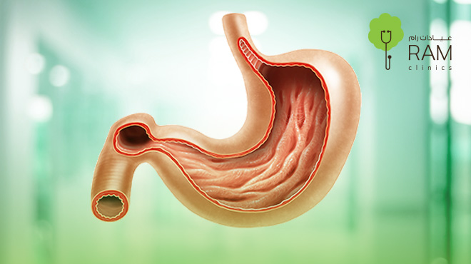 اعراض-قرحة-المعدة