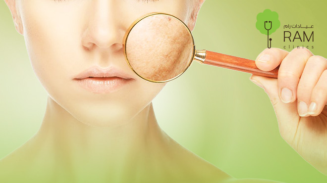 تكلفة-علاج-الكلف-بالليزر