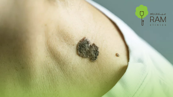 اعراض-سرطان-الجلد-المبكرة