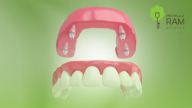 تجربتي-مع-زراعة-عظم-الفك