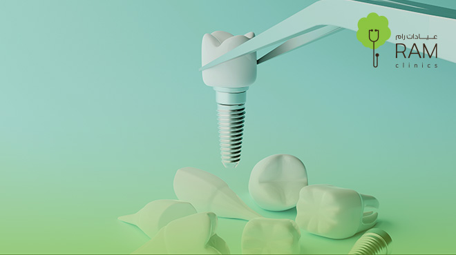 زراعة-الاسنان-الفورية