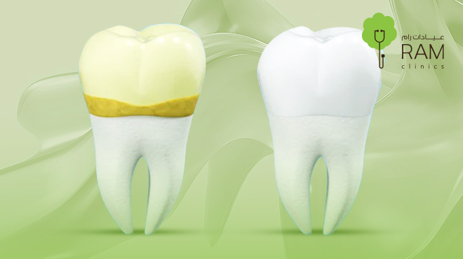 أسباب-تكلس-جذور-الأسنان