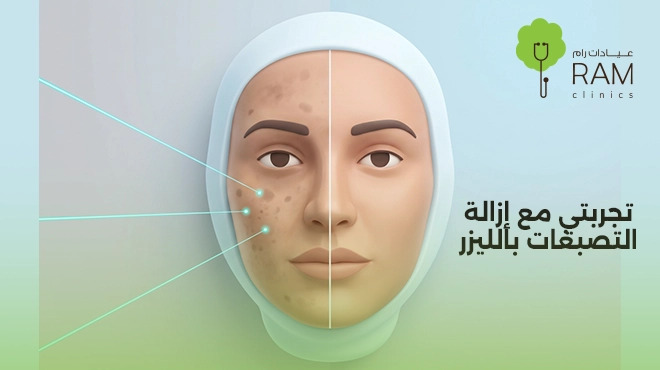 تجربتي-مع-إزالة-التصبغات-بالليزر