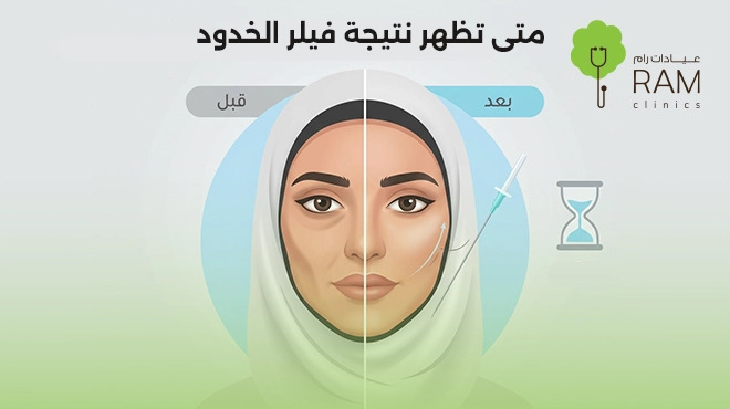 متى-تظهر-نتيجة-فيلر-الخدود