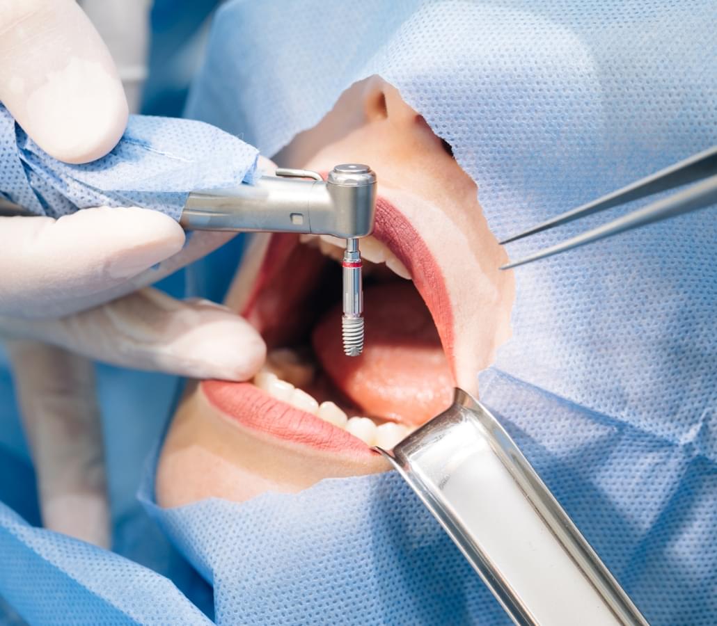 Dental Surgery and Implants
